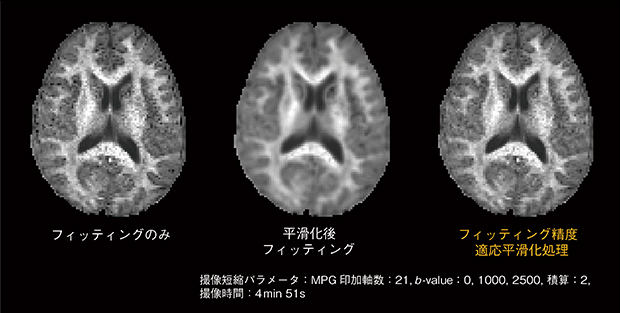 図5　フィッティング精度適応平滑化処理によるDKI（MK）の画質向上