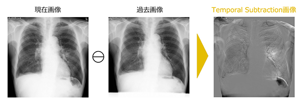 Temporal Subtraction処理（胸部経時差分処理）