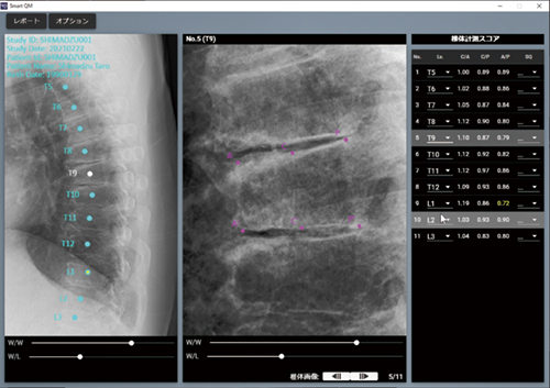 椎体計測ソフトウェア　Smart QM