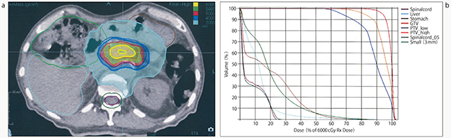 図2　局所進行膵臓がんの症例　 a：線量分布図　b：DVH