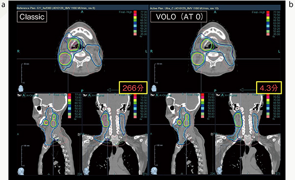 図2　頭頸部がん症例に対するIMRT 頭頸部は複雑な形状のため，従来の最適化プログラム（Classic）では266分かかる線量計算（a）が，VOLO Ultraを利用することにより，4.3分で同等の線量分布（b）が得られている。 AT＝accelerate treatment，0（high compensation）～10（low compensation）