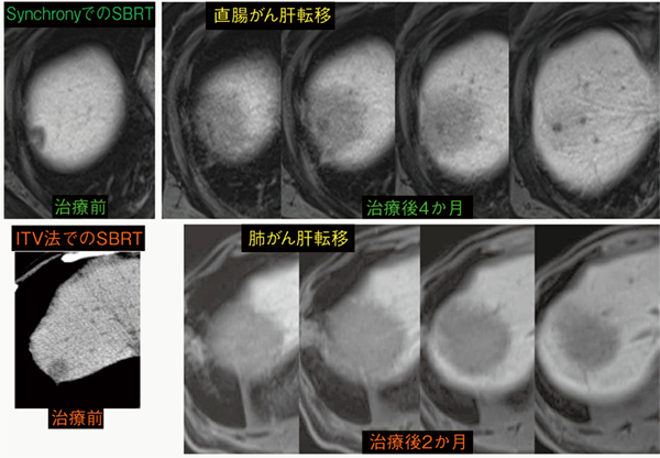 図2　肝転移に対するSynchronyとITV法によるSBRTの比較