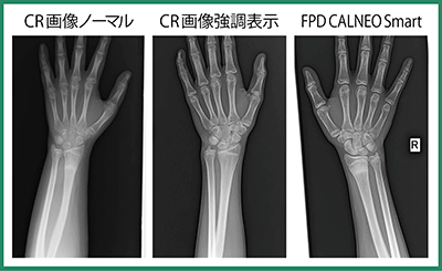 図1　整形外科領域におけるCRとCALNEO Smartの画像比較