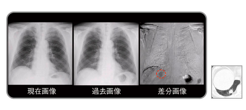 図4　有用症例：右横隔膜下の結節（腺癌）