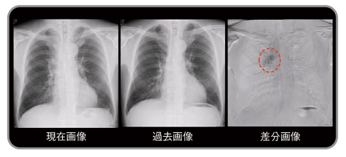 図5　有用症例：境界不鮮明な陰影（小細胞癌）