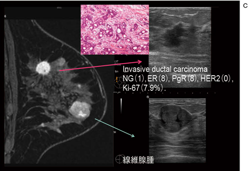 c：‌造影MRI矢状断像，Bモード画像，病理像