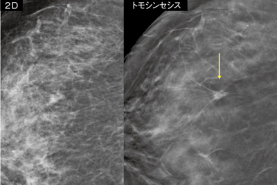 症例1：70歳代，女性，検診発見例