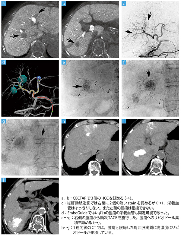 症例：XperCTとEmboGuideを用いたTACE