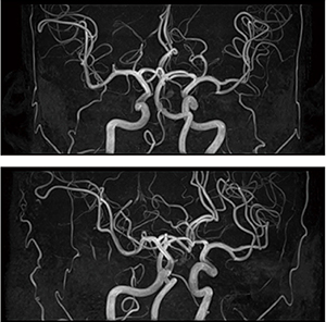 症例1：頭部MRA