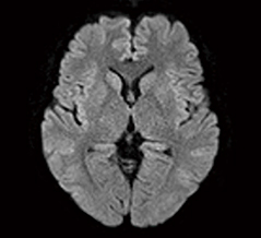 症例2：頭部拡散強調画像（syngo RESOLVE）