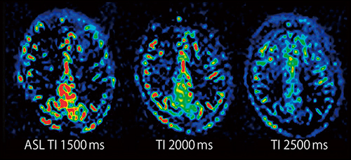 症例3：頭部ASL画像