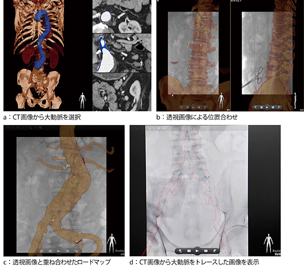 症例1：VesselNavigatorによるステントグラフト内挿術のナビゲーション
