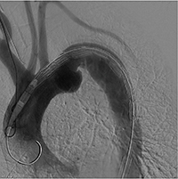 TEVAR術中画像(1) 弓部分枝が鮮明に描出され，より正確な位置合わせが可能。