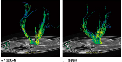 図7　DTI解析結果