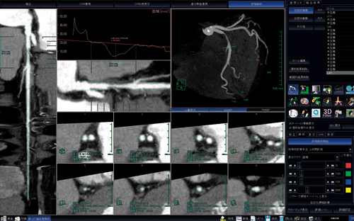 図3　冠動脈狭窄解析