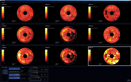 図5　心筋パフュージョン解析結果