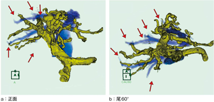 図4　血管塞栓術後のMRA（正面・尾60°）