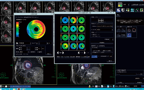 図5　Bull's eyeなどによる心機能解析