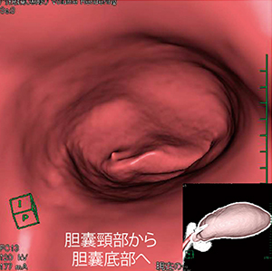 図5　仮想内視鏡応用例2