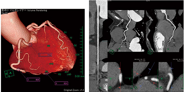 図7　右冠動脈の解析