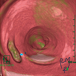 図7　ポリープと残渣を色分けしたカラーマップ