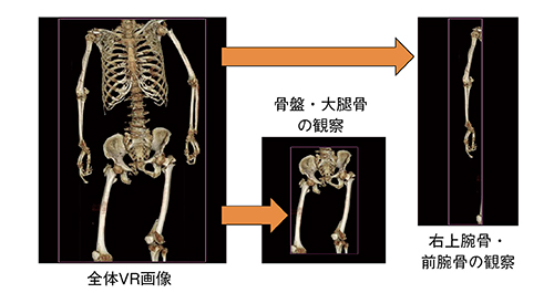 図3　症例1：クリッピング機能の有効活用