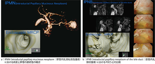 図3　endoscopic MRCP