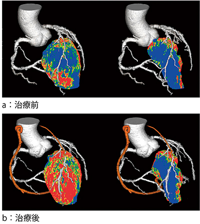 図5　CTPとCTAのフュージョン画像