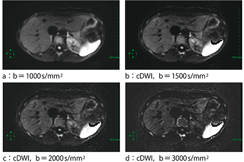 図2　実際のcDWIの画像