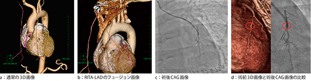 図5　冠動脈疾患3枝病変に対するMICS CABGのRITA-LAD，I-graft（LITA＋free GEA）-LCX＃14-#4PD）