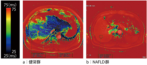 図4　VirtualPlaceによる肝臓T1ρ map