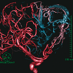 図5　3D-DSA元画像を用いたVR画像（静脈奇形によるA-Vシャント）