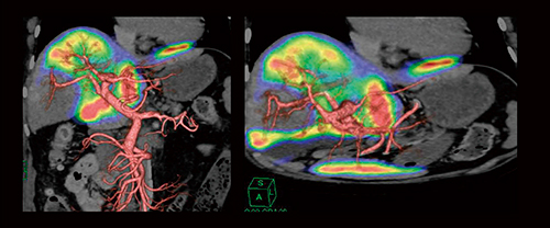 図10　アシアロシンチグラフィと3D-CTPのフュージョン画像（HCC）