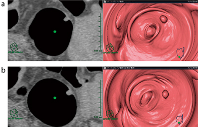 図2　比較読影モード 仰臥位（a），腹臥位（b）とも同じ位置に隆起性病変が見られ，残渣ではない（CT値40HU）。