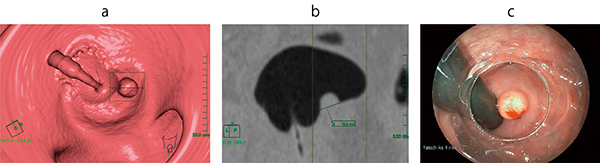 図3　ポリープ（直腸カルチノイド）の計測 a：仮想内視鏡画像でのポリープ観察ツール使用時 b：ポリープ観察ツールでの直交断面画像（大きさ10.2mm，CT値44HU） c：同部位の内視鏡画像