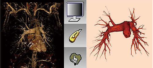 図2　肺動脈の抽出 肺静脈（図1 c）を全体像から引き算すると周囲のゴミが多く残るため，肺動脈末梢が消えないよう慎重にウィンドウ調節して，カッターと選択抽出で肺動脈を抽出する。