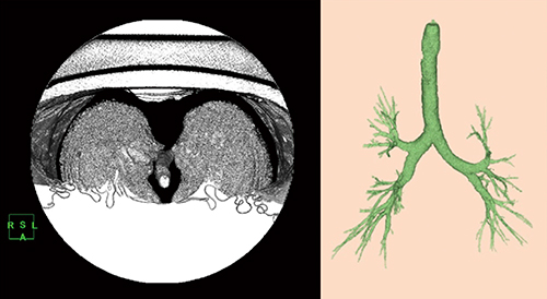 図5　気管支の抽出 SSD（shaded surface display）表示の閾値を−2000～−890HU程度にして気管支を選択抽出する。描出されない末梢は修復ツールで補足する。