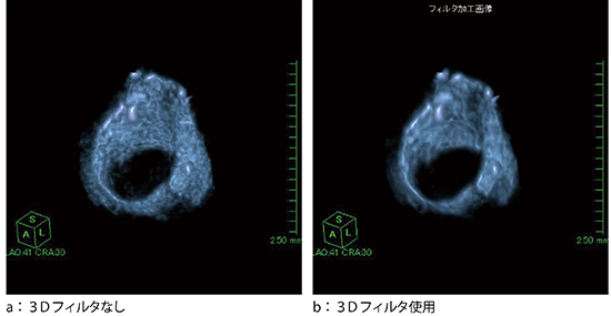 図5　3Dフィルタ使用の有無による画像の比較（輪状軟骨）