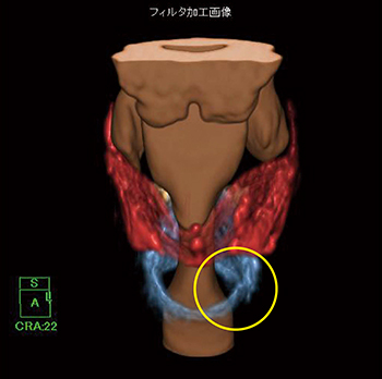 図6　3Dフィルタを使用した喉頭軟骨VR画像