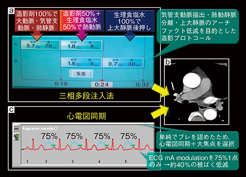 図1　造影プロトコール・撮影プロトコール a：造影剤と生理食塩水の三相多段注入法 b：三相多段注入法によってコントラストに優れた元画像を取得 c：大焦点での心電図同期撮影，ECG mA modulationの使用