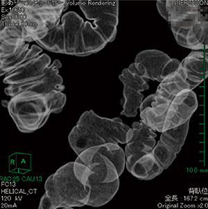 図4　仮想注腸像を任意角度で表示