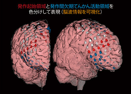 図3　発作起始領域と発作間欠期てんかん活動領域の色分け