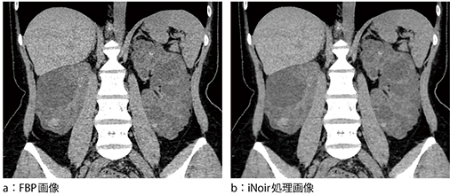 図6　症例3：多発性囊胞腎（30歳代，女性）