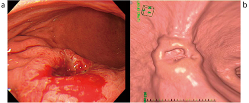 図3　症例1の内視鏡像（a）と仮想内視鏡像（b）