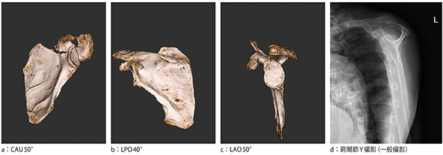 図1　症例1：肩甲骨骨折（77歳，男性）