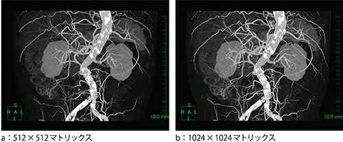 図3　高精細CT画像（腹部造影CTのMIP画像）