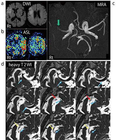 図1　来院時DWI（a），ASL（b），MRA（c），3D-heavy T2WI（d） 右前頭葉に新しい梗塞巣を認め（a），同部より広い範囲で脳血流低下を認める（b）。MRA（c）では右中大脳動脈水平部に閉塞を認め（↓），3D-heavy T2WI（d）では開存している血管（→），閉塞部血栓（↓），閉塞後の血管（↓）を確認できる。
