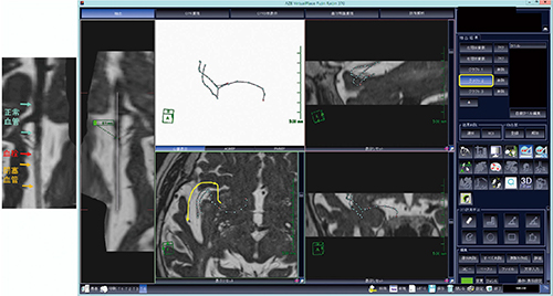 図4　中大脳動脈分枝の画像化（2本目） グラフト2を選択して，中大脳動脈分岐部から閉塞した血管を追跡する。CPR像では閉塞血管内の血栓の位置の確認や，血管外径の計測が可能である。