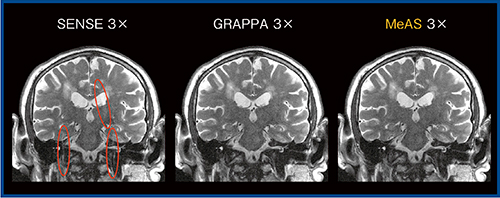 図2　各種parallel imagingの画像比較（W.I.P.）