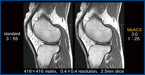 図6　膝の高分解能画像におけるMeACSの有用性（W.I.P.）